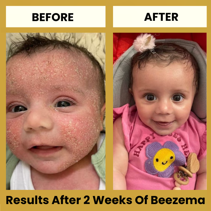 HoneyCalm™ Eczema Cream