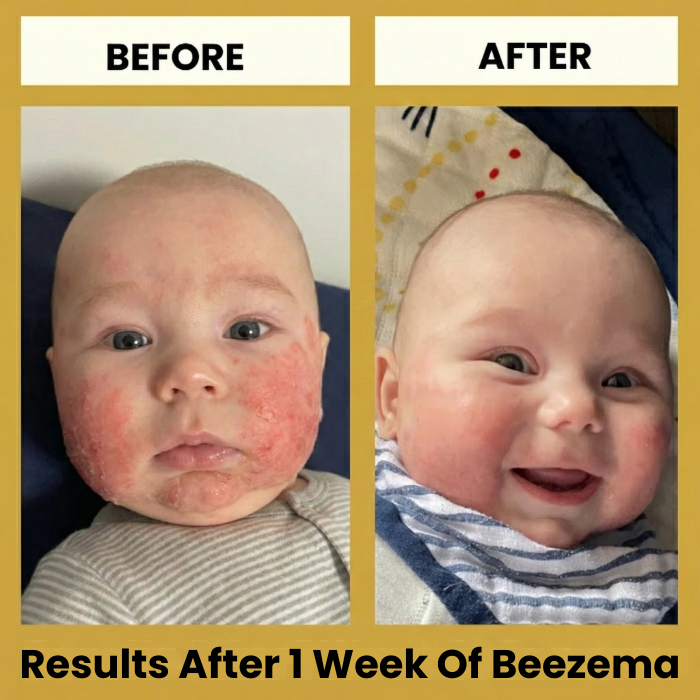 HoneyCalm™ Eczema Cream