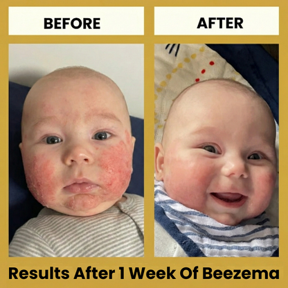 HoneyCalm™ Eczema Cream
