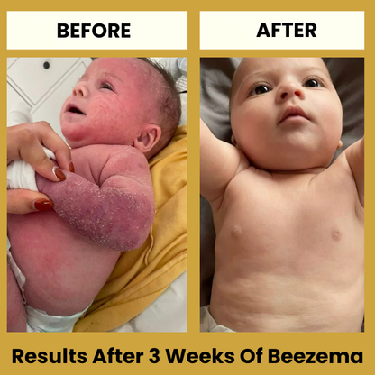 HoneyCalm™ Eczema Cream